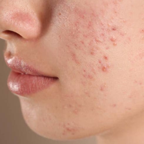 Acne & Acne Scarring