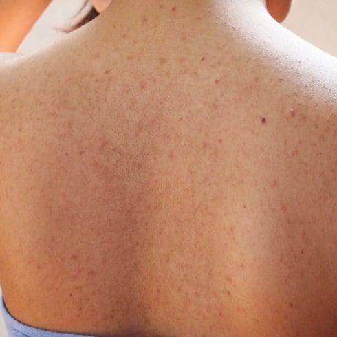 Back Acne