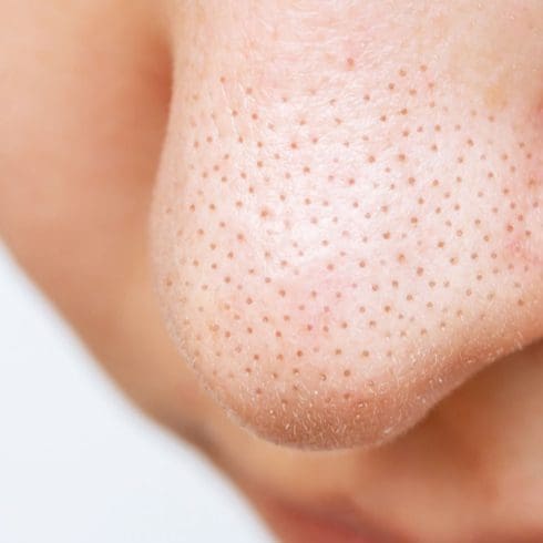 Enlarged Pores / Congestion