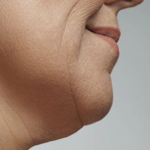 Turkey Neck / Neck Fat