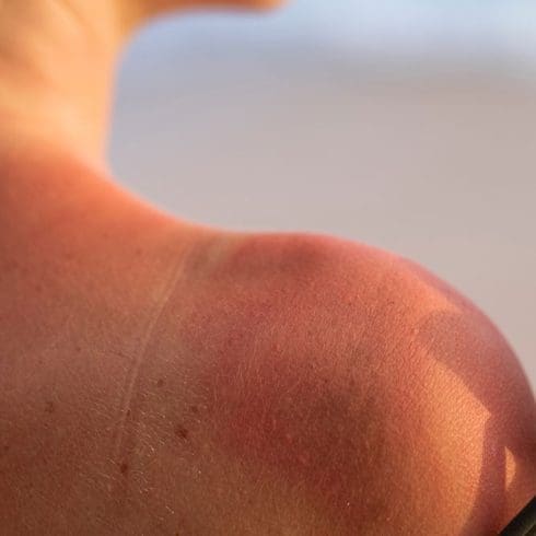 Sun Damage