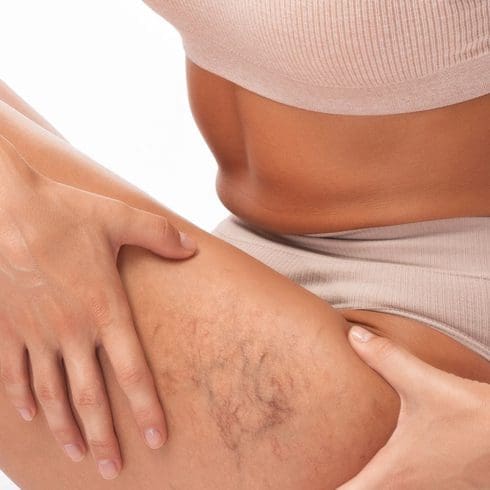 Thread Veins & Pigmentation