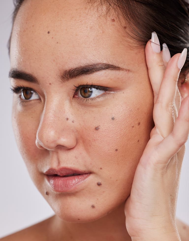 Refresh Medispa - About Mole Checks & Skin Lesion Review