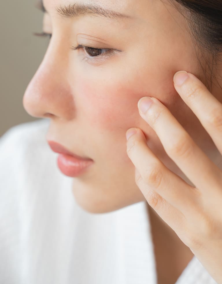 Refresh Medispa - About Rosacea Treatment