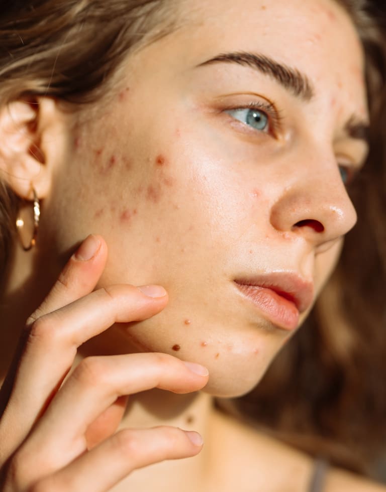 Refresh Medispa - Acne Treatment At a Glance