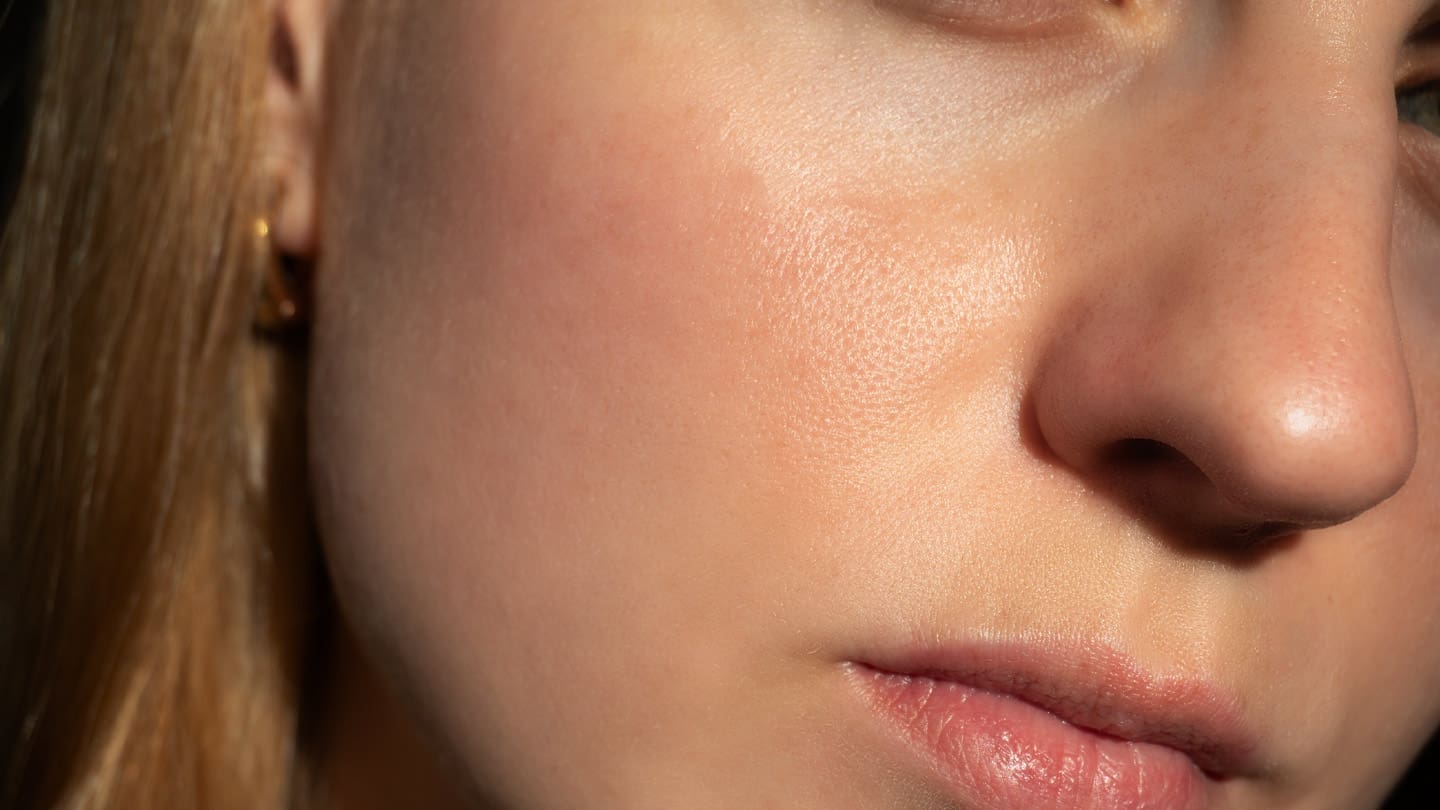 Refresh-Medispa-Rosacea-Treatment-Header