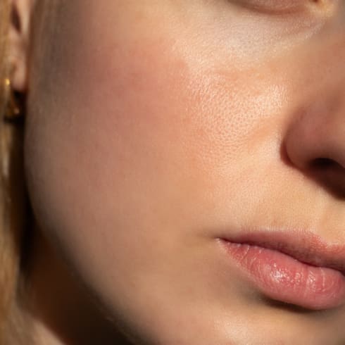 Rosacea Treatment