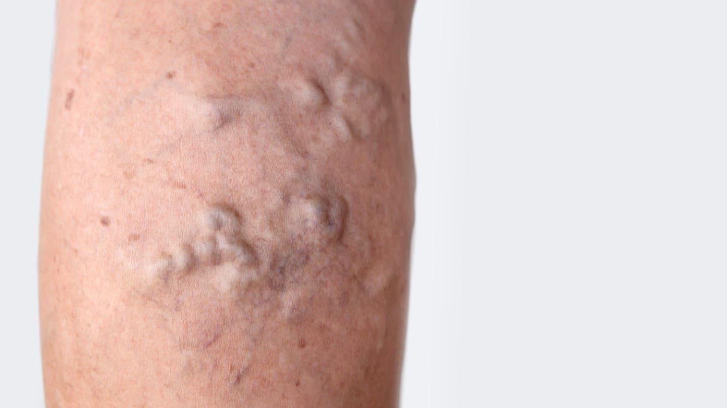 refresh-medispa-varicose veins-desktop