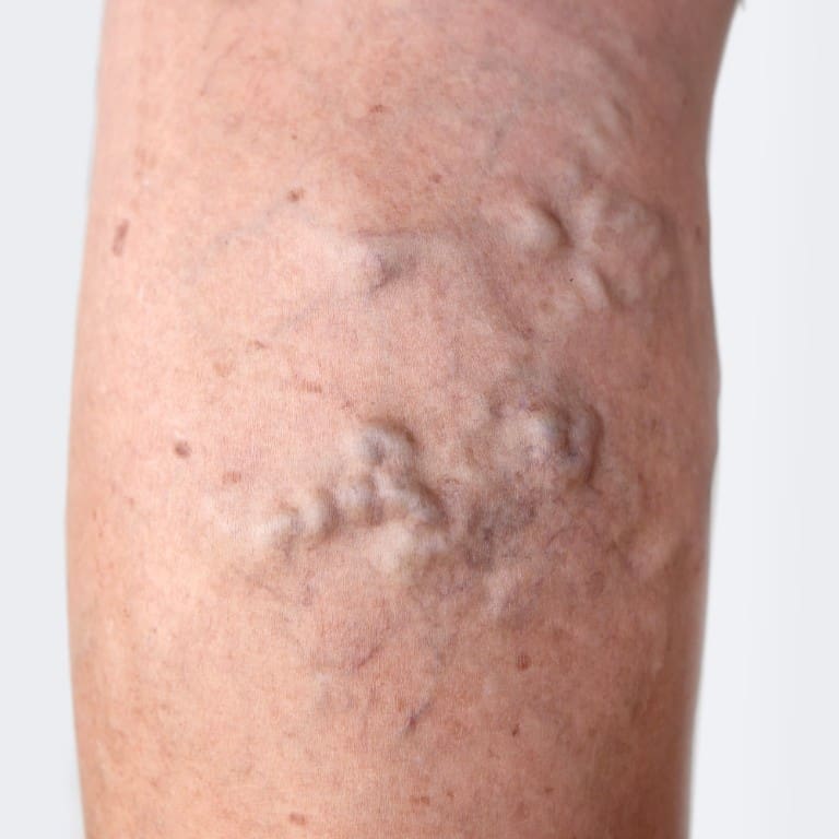 refresh-medispa-varicose veins-mobile